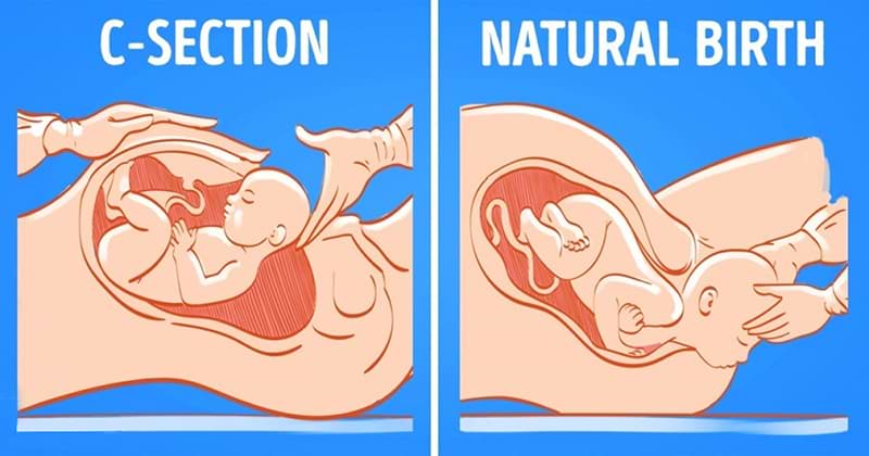 Delivery And C-Section